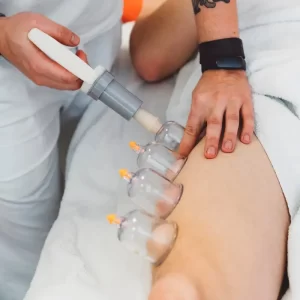 Cupping Therapy (Back)
