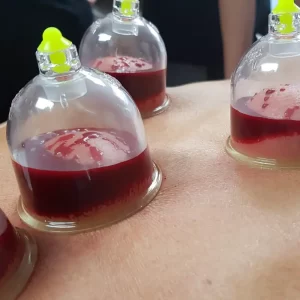 Hizma Cupping