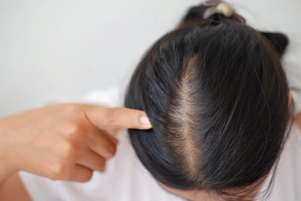 hairfall-treatment-in-women